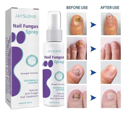 Nail Fungus Spray for Fast Relief, Healing, and Prevention of Fungal Infections on Nails!